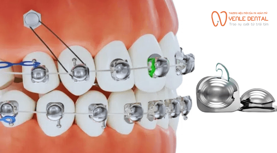niềng răng mắc cài cánh cam